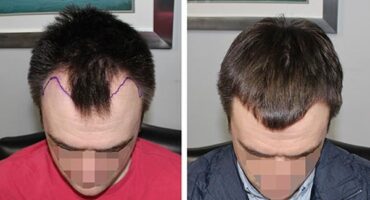 Patient 19 Hair Photos- FELLER & BLOXHAM MEDICAL