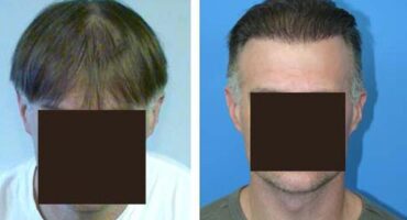 Patient 4 Hair Photos- FELLER & BLOXHAM MEDICAL