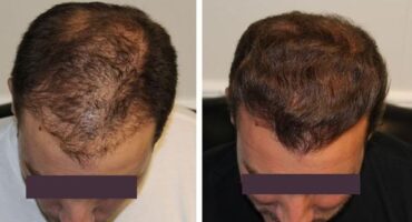 Patient 5 Hair Photos- FELLER & BLOXHAM MEDICAL