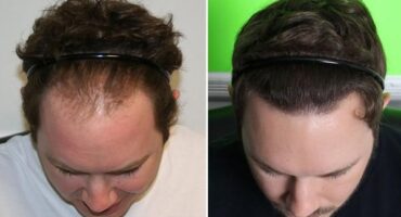 Patient 6 Hair Photos- FELLER & BLOXHAM MEDICAL