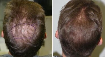 Patient 8 Hair Photos- FELLER & BLOXHAM MEDICAL
