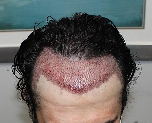 After a Hair Transplant